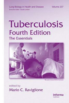 Tuberculosis: The Essentials, Fourth Edition by 