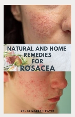 Natural and Home Remedies for Rosacea: A Self Help Guide To Completely Prevent and Treat Rosacea by Elizabeth David