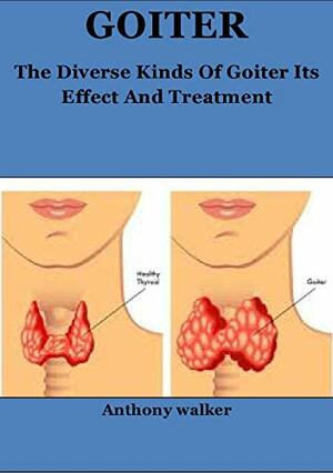 Goiter: The Diverse Kinds Of Goiter Its Effect And Treatment by Anthony Walker