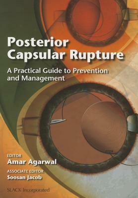 Posterior Capsular Rupture: A Practical Guide to Prevention and Management by Amar Agarwal