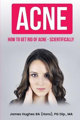 Acne: How to get rid of acne - scientifically by James Hughes