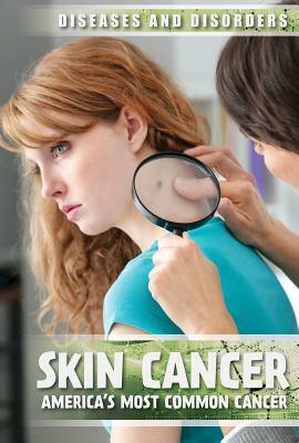Skin Cancer: America's Most Common Cancer by Peter Kurch