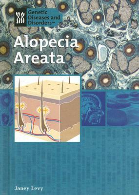 Alopecia Areata by Janey Levy