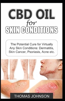 CBD Oil for Skin Conditions: The Potential Cure for Virtually Any Skin Conditions: Dermatitis, Skin Cancer, Psoriasis, Acne etc. by Thomas Johnson