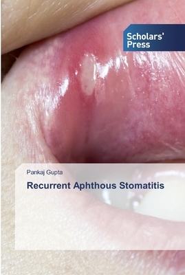 Recurrent Aphthous Stomatitis by Pankaj Gupta