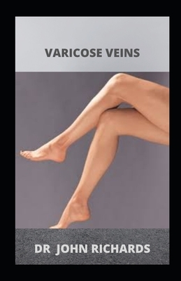 Varicose Veins: A Simple Guide About varicose veins And Its Natural Remedy! by John Richards