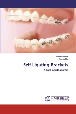 Self Ligating Brackets by Gaurav Rai, Neha Rathore