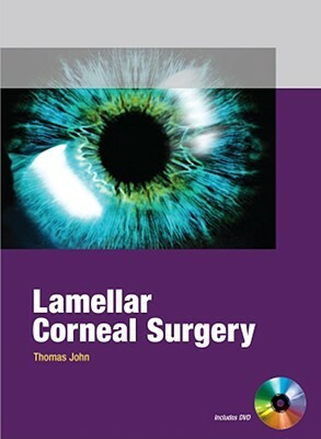 Lamellar Corneal Surgery by Thomas John