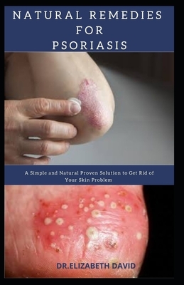 Natural Remedies for Psoriasis: A Simple and Natural Proven Solution to Get Rid of Your Skin Problem: Dermatitis, Eczema, Psoriasis & Rosacea and Othe by Elizabeth David