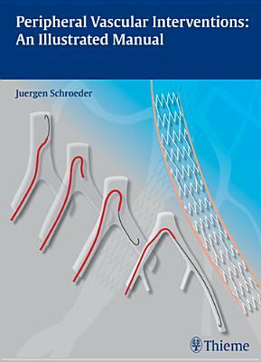 Peripheral Vascular Interventions: An Illustrated Manual by Juergen Schroeder, Jürgen Schröder